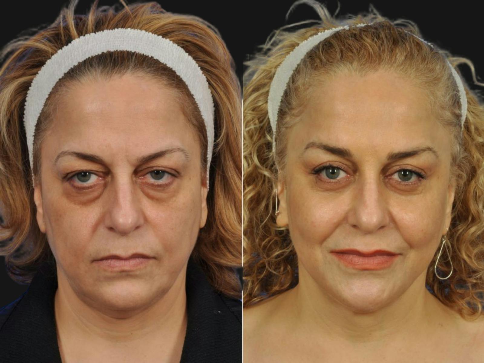Blepharoplasty Before & After Gallery - Patient 243351 - Image 1