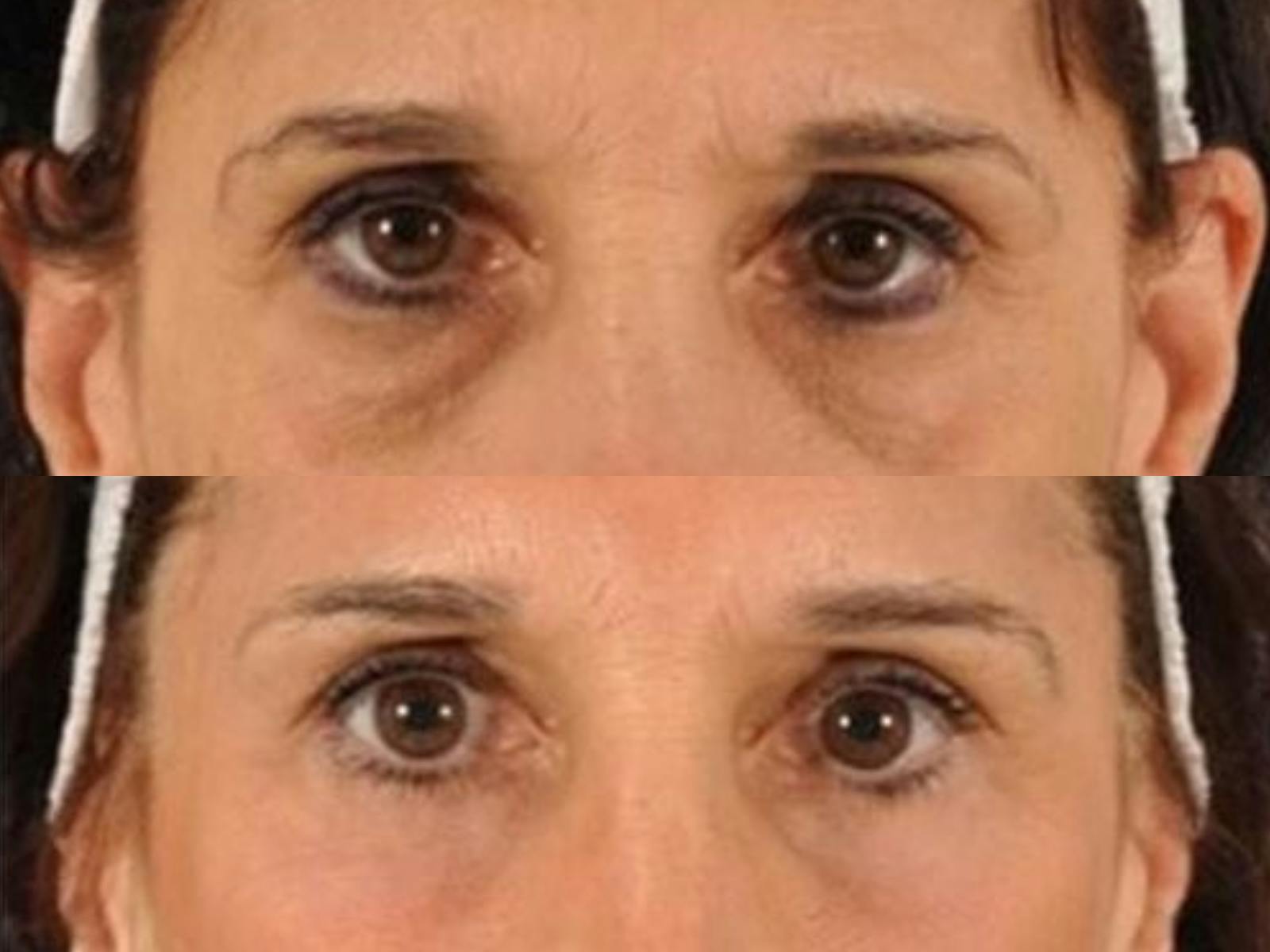 Blepharoplasty Before & After Gallery - Patient 313998 - Image 2