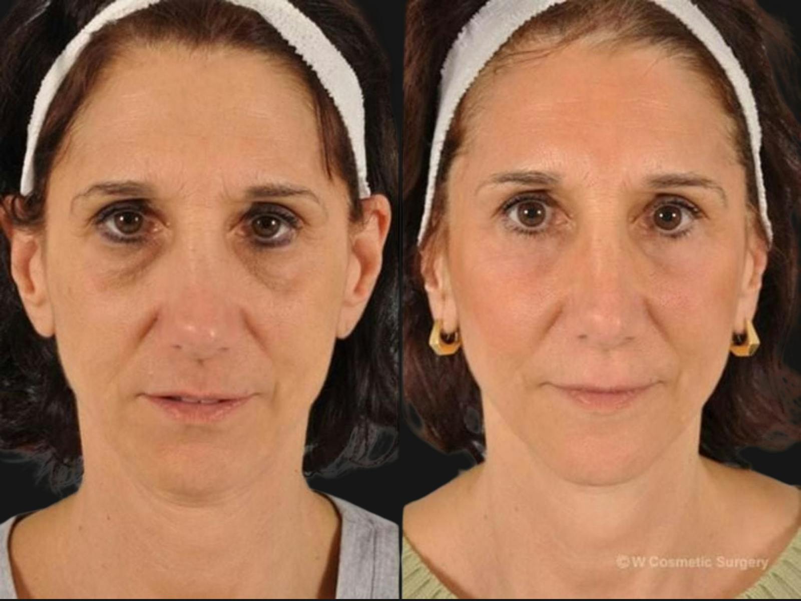 Blepharoplasty Before & After Gallery - Patient 313998 - Image 1