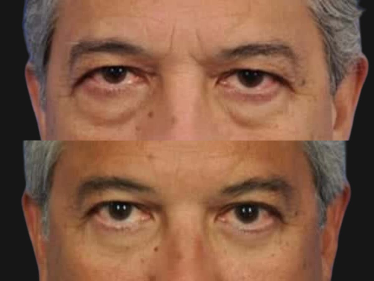 Blepharoplasty Before & After Gallery - Patient 218069 - Image 2
