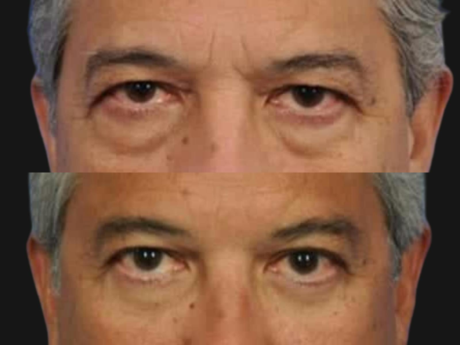 Blepharoplasty Before & After Gallery - Patient 218069 - Image 2