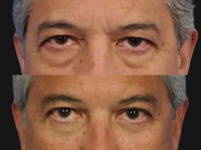 Blepharoplasty Before & After Gallery - Patient 218069 - Image 2