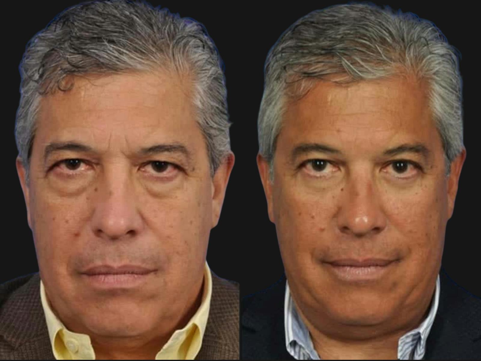 Blepharoplasty Before & After Gallery - Patient 218069 - Image 1