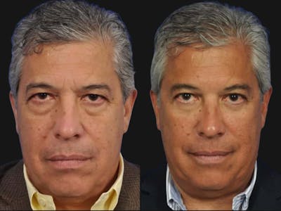 Blepharoplasty Before & After Gallery - Patient 218069 - Image 1