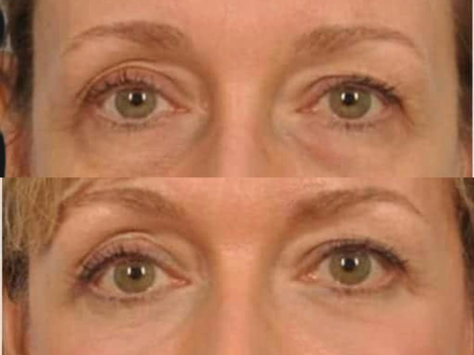 Blepharoplasty Before & After Gallery - Patient 279683 - Image 2