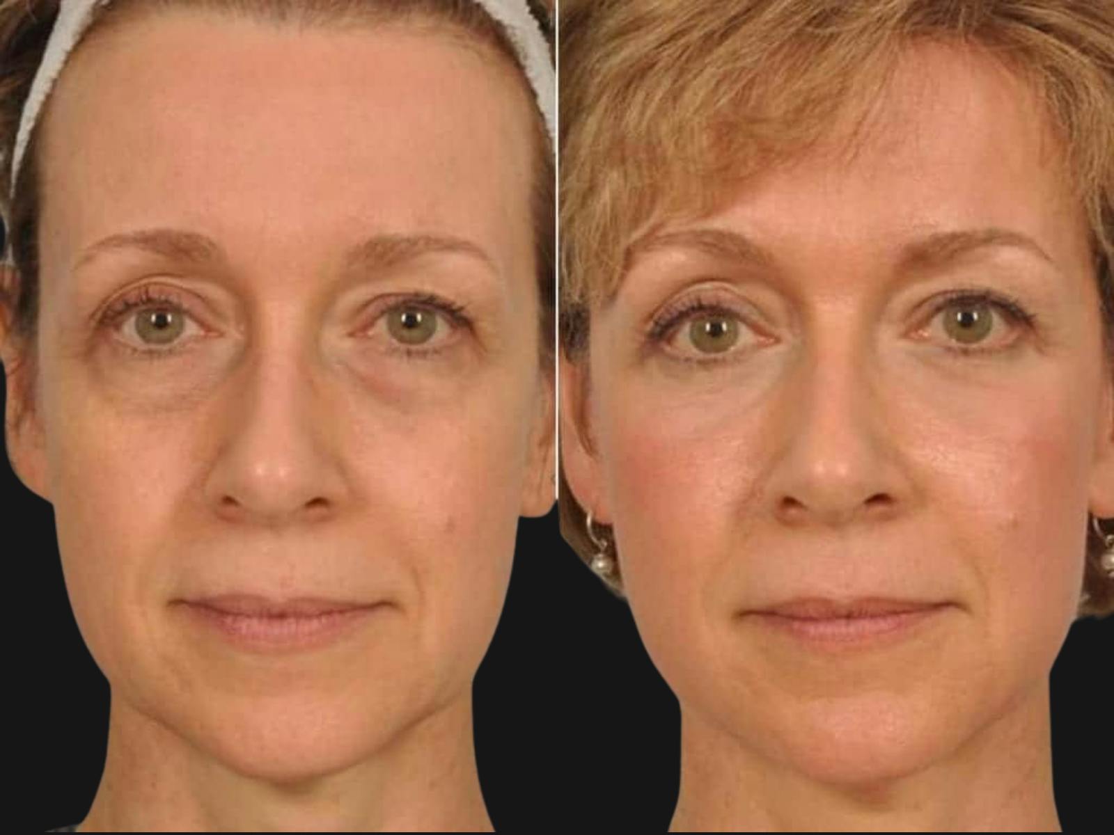 Blepharoplasty Before & After Gallery - Patient 279683 - Image 1