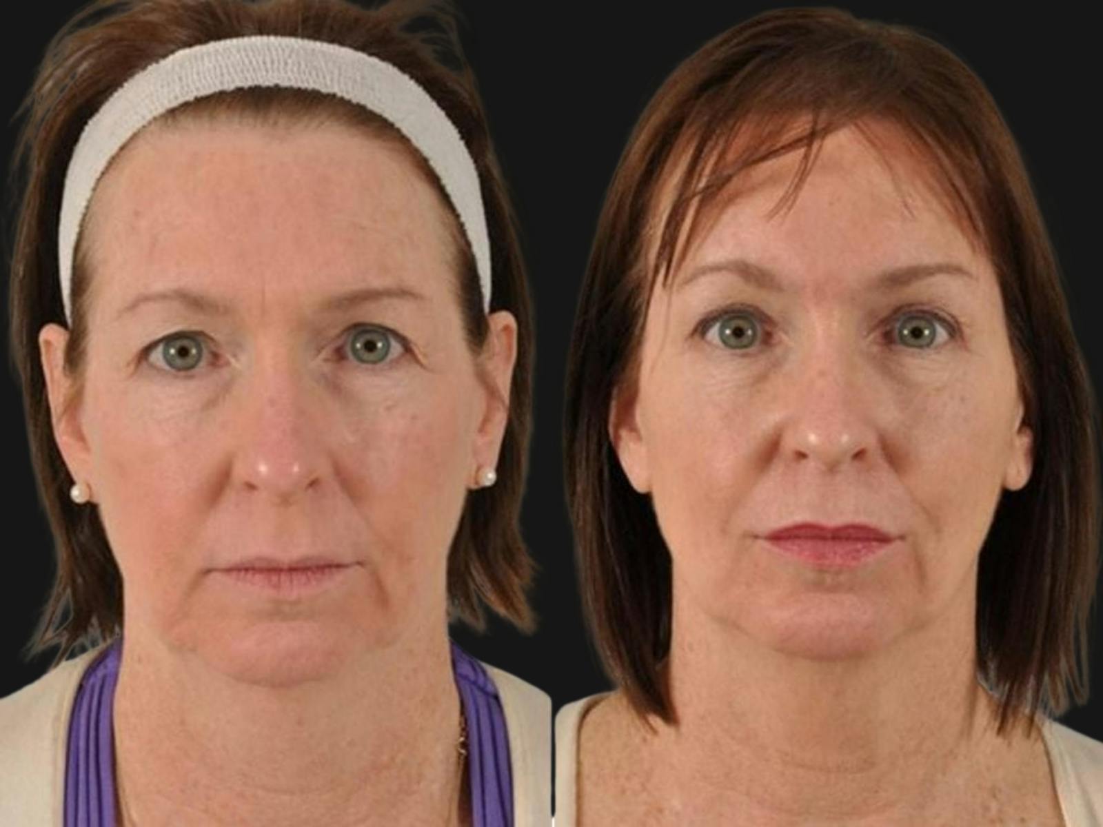 Blepharoplasty Before & After Gallery - Patient 601256 - Image 1
