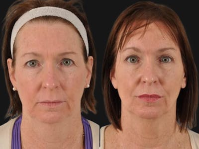 Blepharoplasty Before & After Gallery - Patient 601256 - Image 1