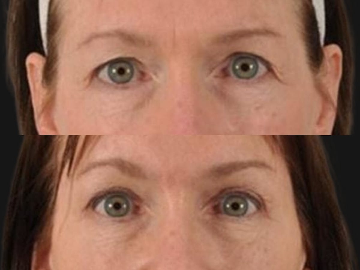 Blepharoplasty Before & After Gallery - Patient 601256 - Image 2