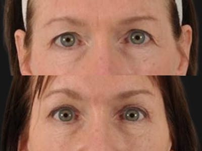 Blepharoplasty Before & After Gallery - Patient 601256 - Image 2
