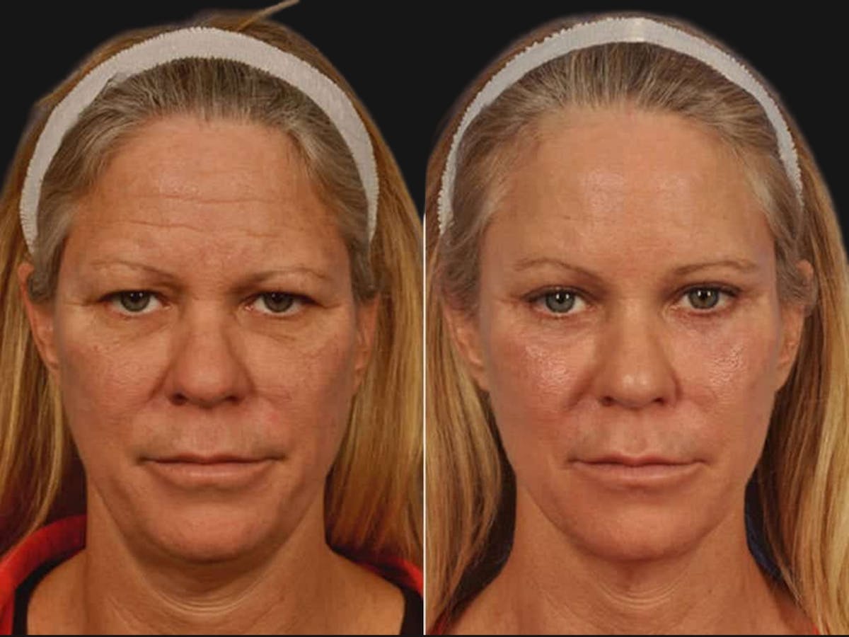 Blepharoplasty Before & After Gallery - Patient 297051 - Image 1