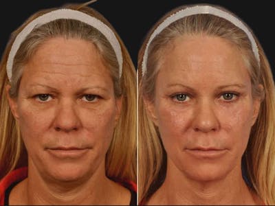 Blepharoplasty Before & After Gallery - Patient 297051 - Image 1