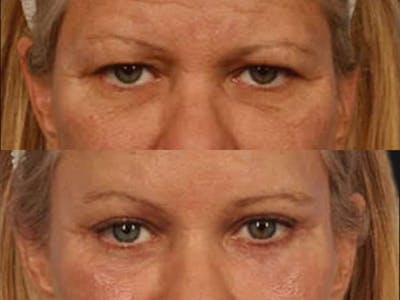 Blepharoplasty Before & After Gallery - Patient 297051 - Image 2