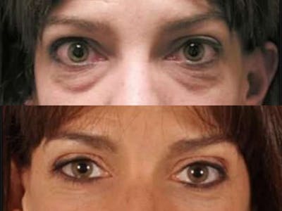 Blepharoplasty Before & After Gallery - Patient 172436 - Image 2
