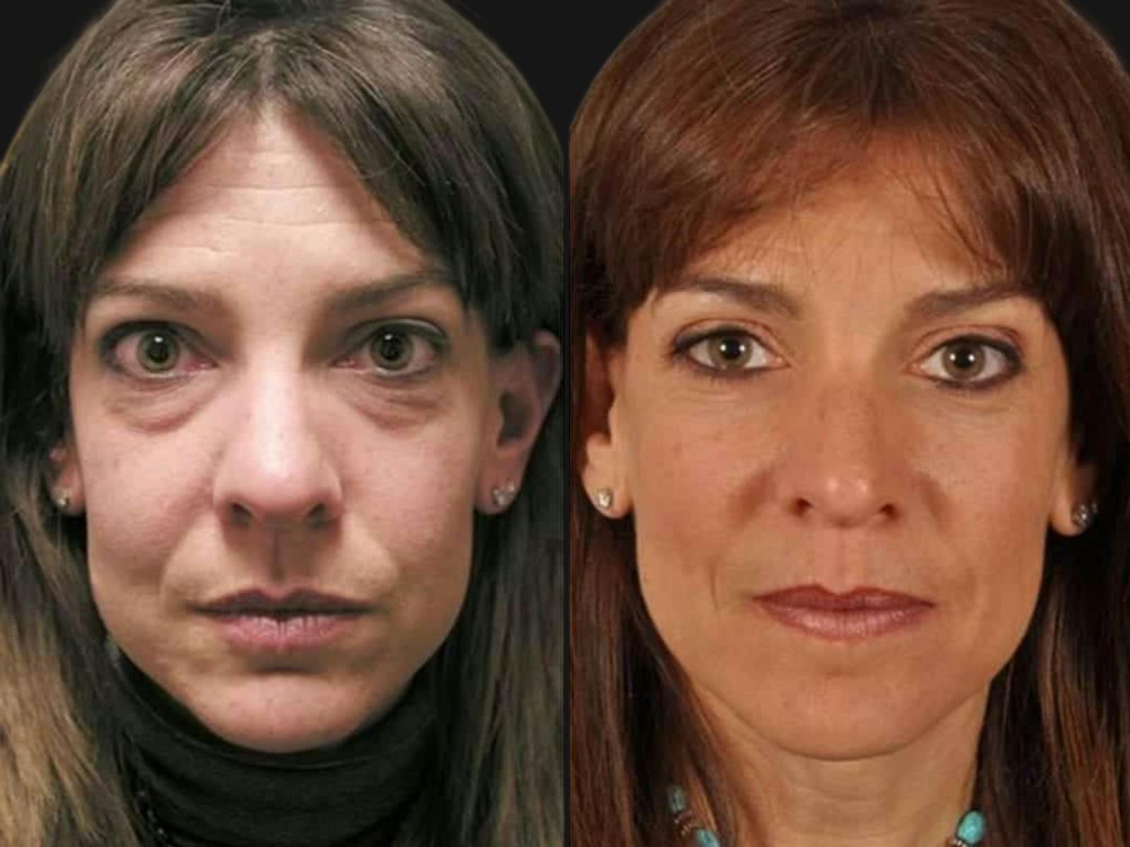 Blepharoplasty Before & After Gallery - Patient 172436 - Image 1