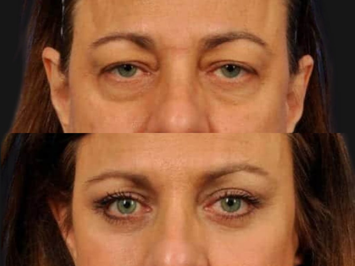 Blepharoplasty Before & After Gallery - Patient 292294 - Image 2
