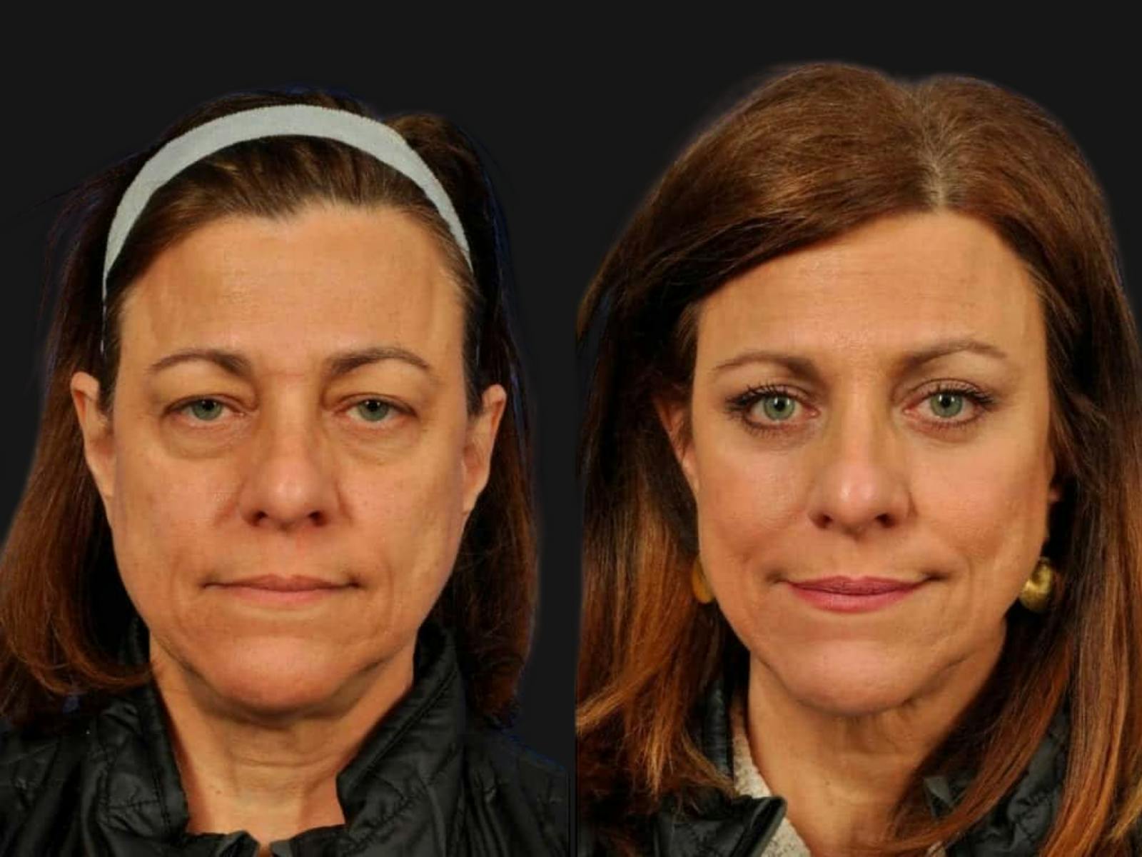 Blepharoplasty Before & After Gallery - Patient 292294 - Image 1