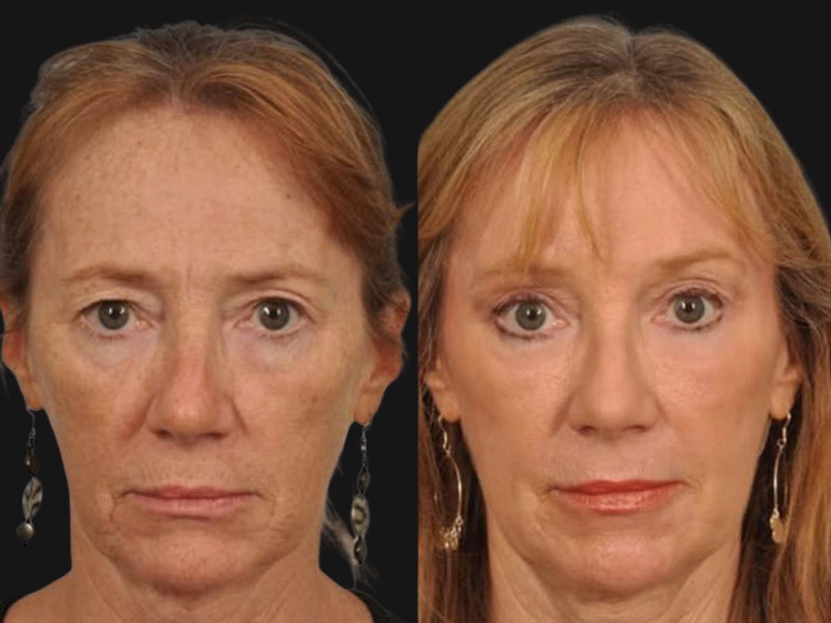 Blepharoplasty Before & After Gallery - Patient 476584 - Image 1