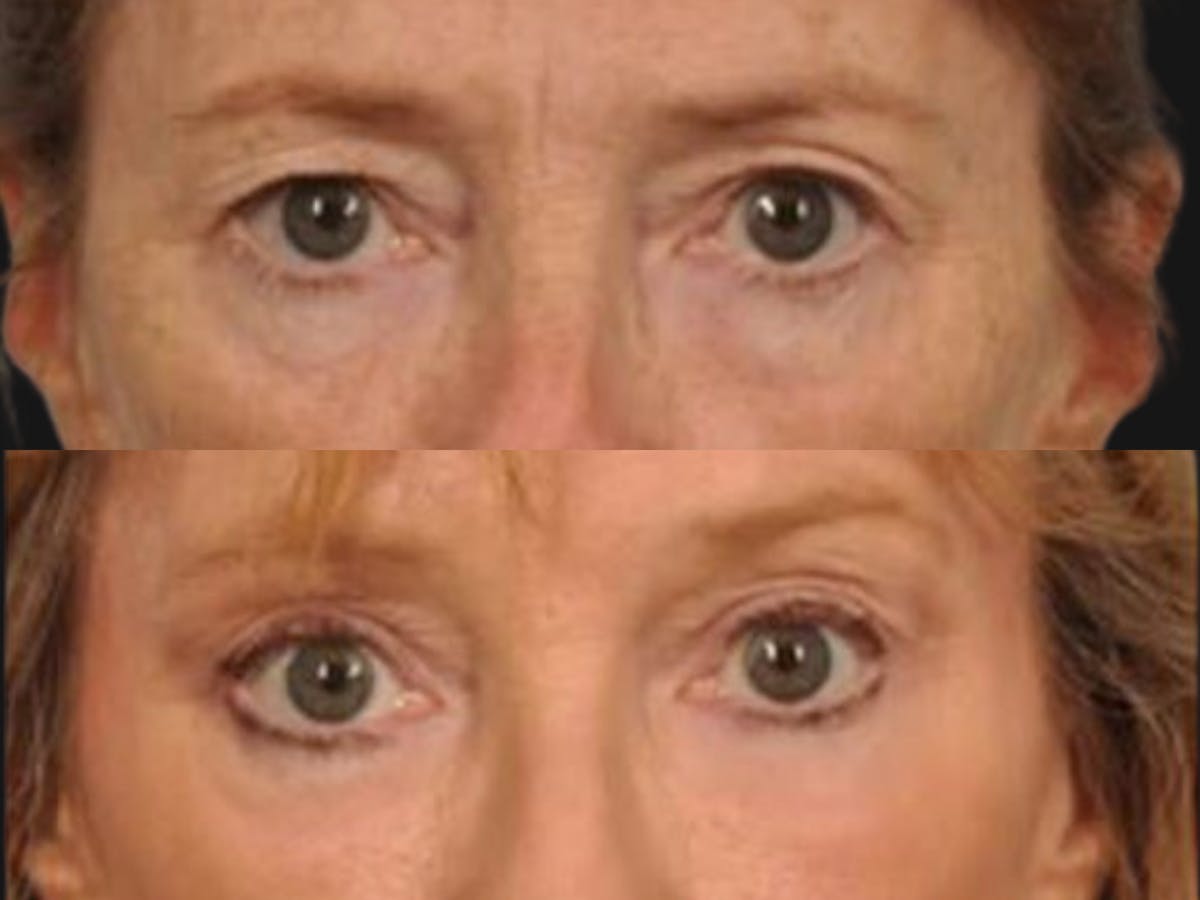 Blepharoplasty Before & After Gallery - Patient 476584 - Image 2