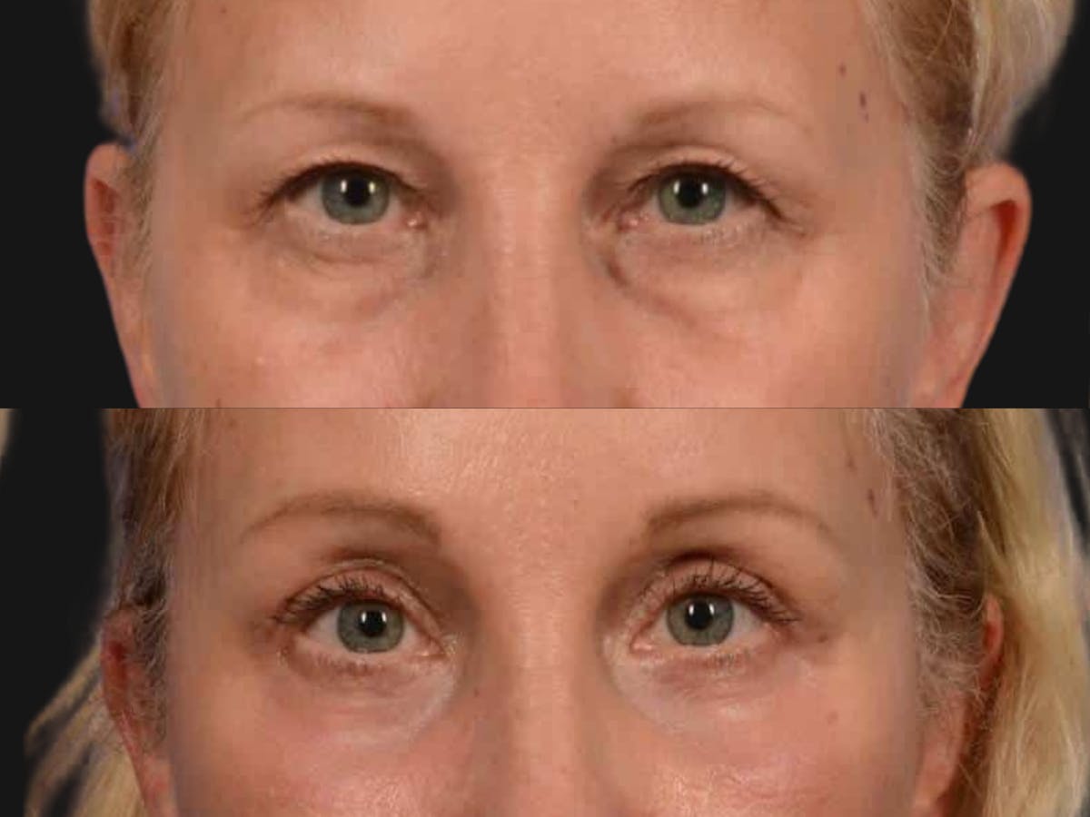 Blepharoplasty Before & After Gallery - Patient 337982 - Image 2