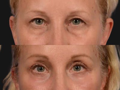 Blepharoplasty Before & After Gallery - Patient 337982 - Image 2