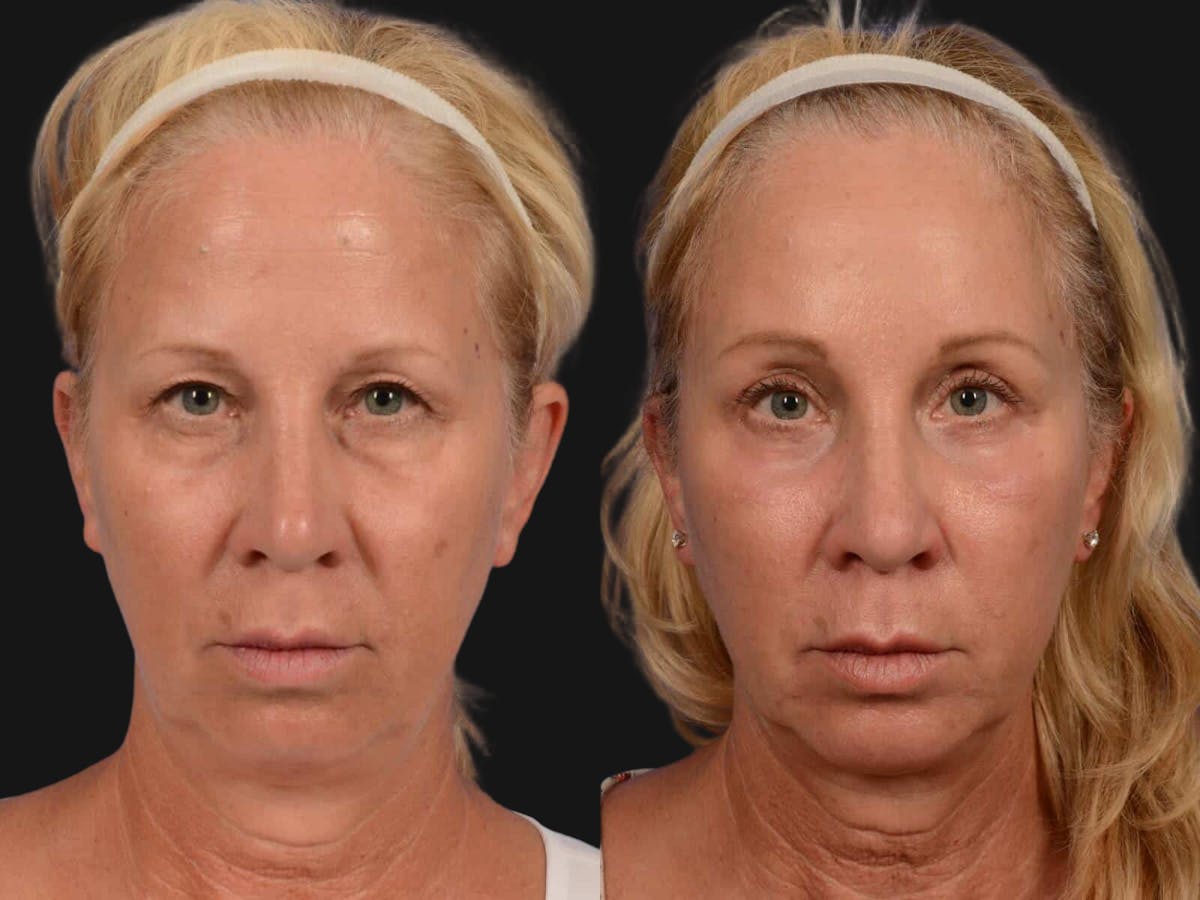 Blepharoplasty Before & After Gallery - Patient 337982 - Image 1