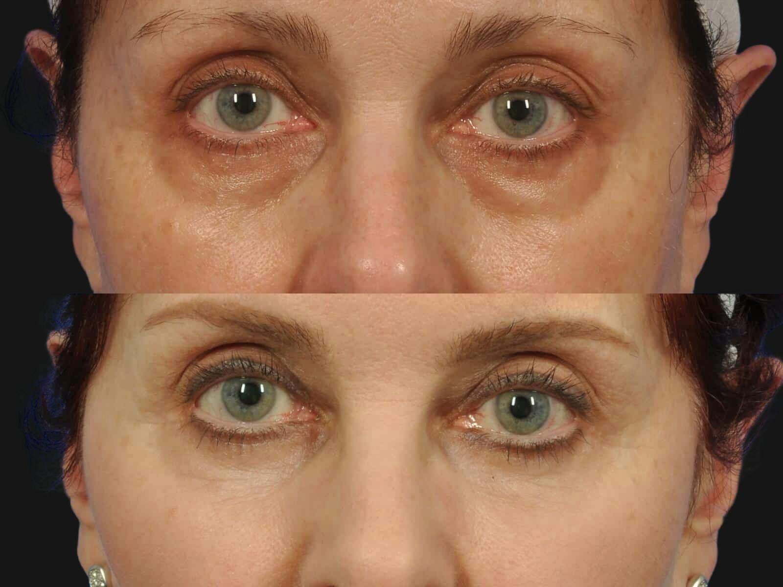 Blepharoplasty Before & After Gallery - Patient 104682 - Image 2