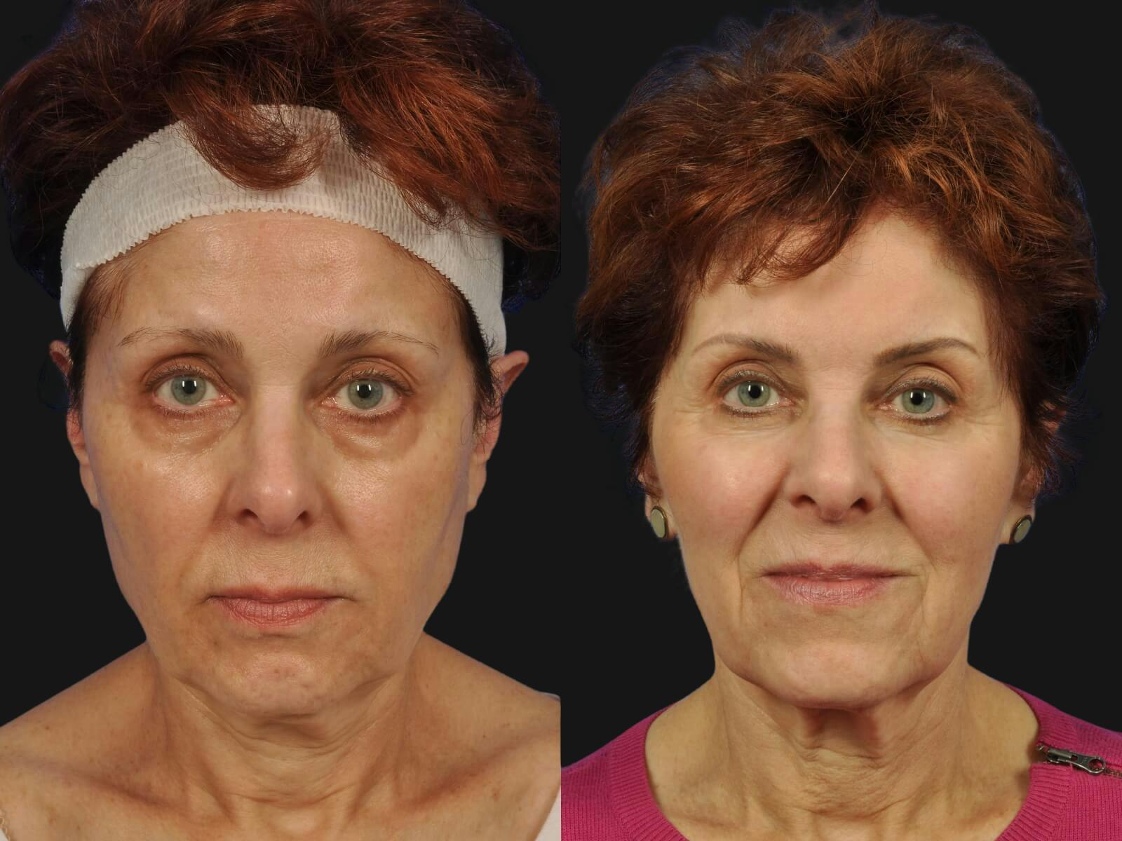 Blepharoplasty Before & After Gallery - Patient 104682 - Image 1