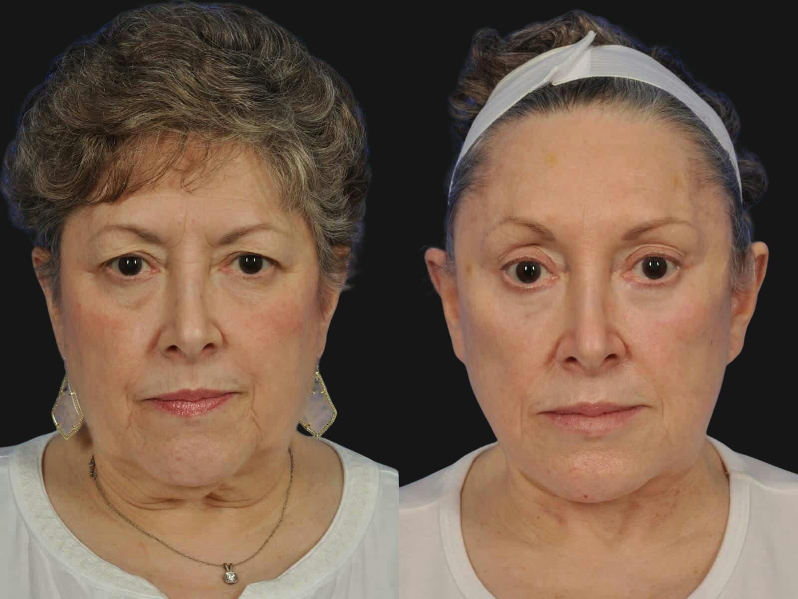 Blepharoplasty Before & After Gallery - Patient 266015 - Image 1