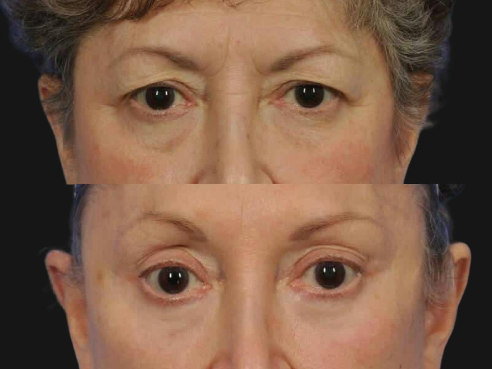 Blepharoplasty Before & After Gallery - Patient 266015 - Image 2