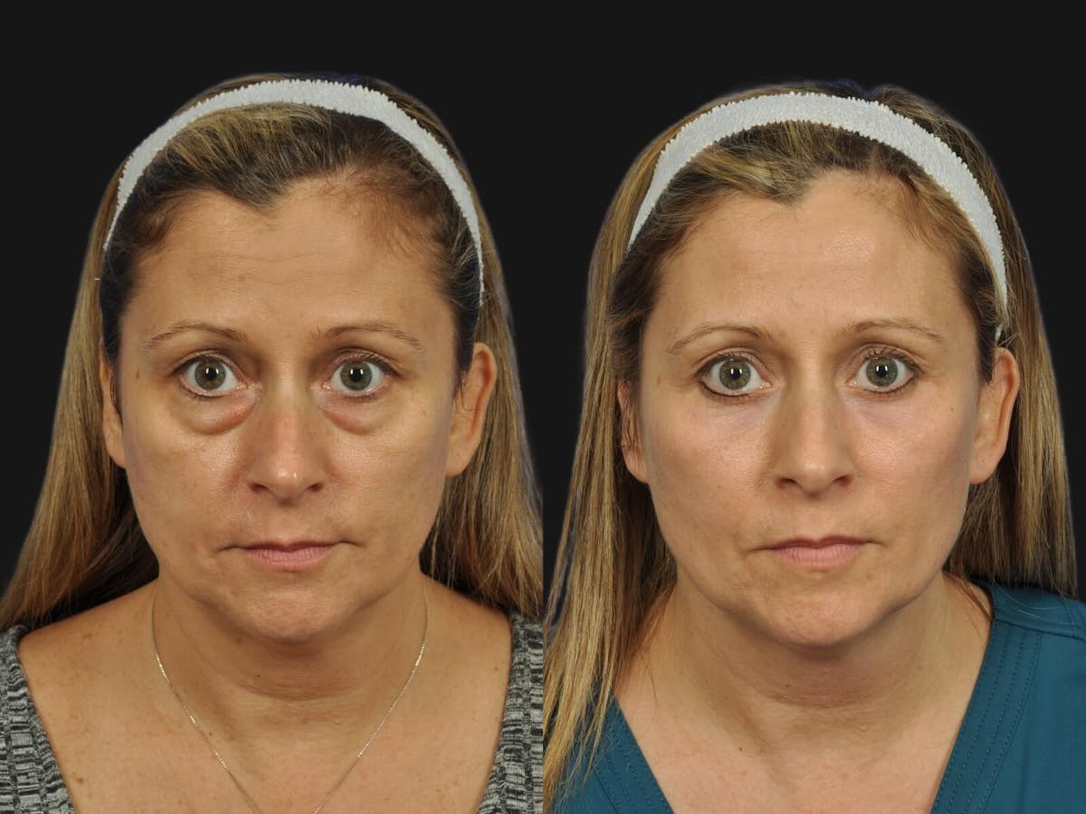 Blepharoplasty Before & After Gallery - Patient 100590 - Image 1