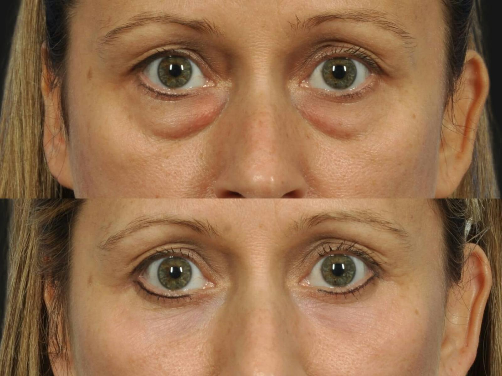 Blepharoplasty Before & After Gallery - Patient 100590 - Image 2