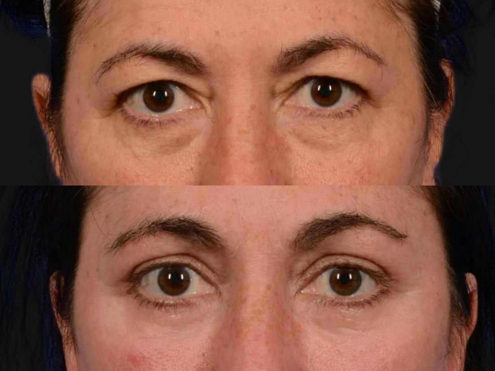 Blepharoplasty Before & After Gallery - Patient 422115 - Image 2