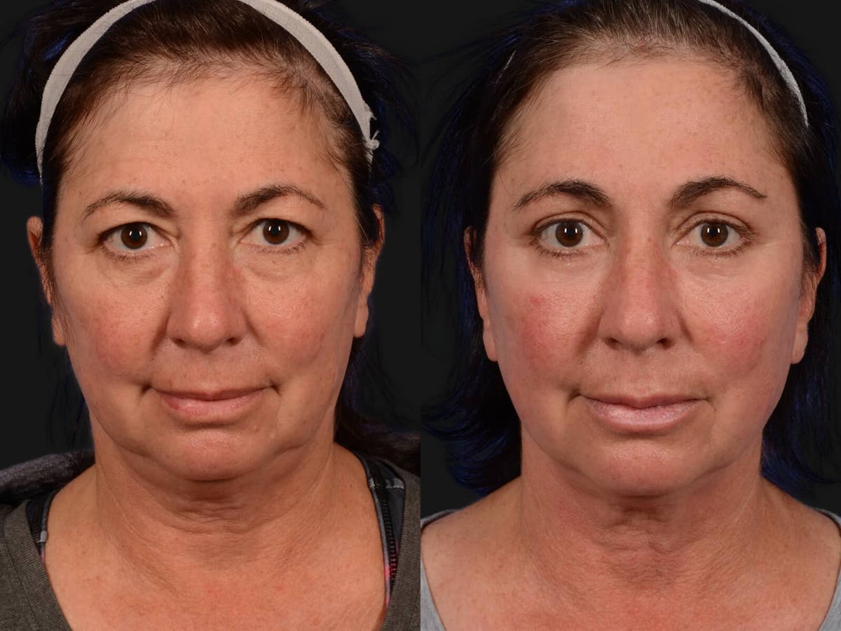 Blepharoplasty Before & After Gallery - Patient 422115 - Image 1