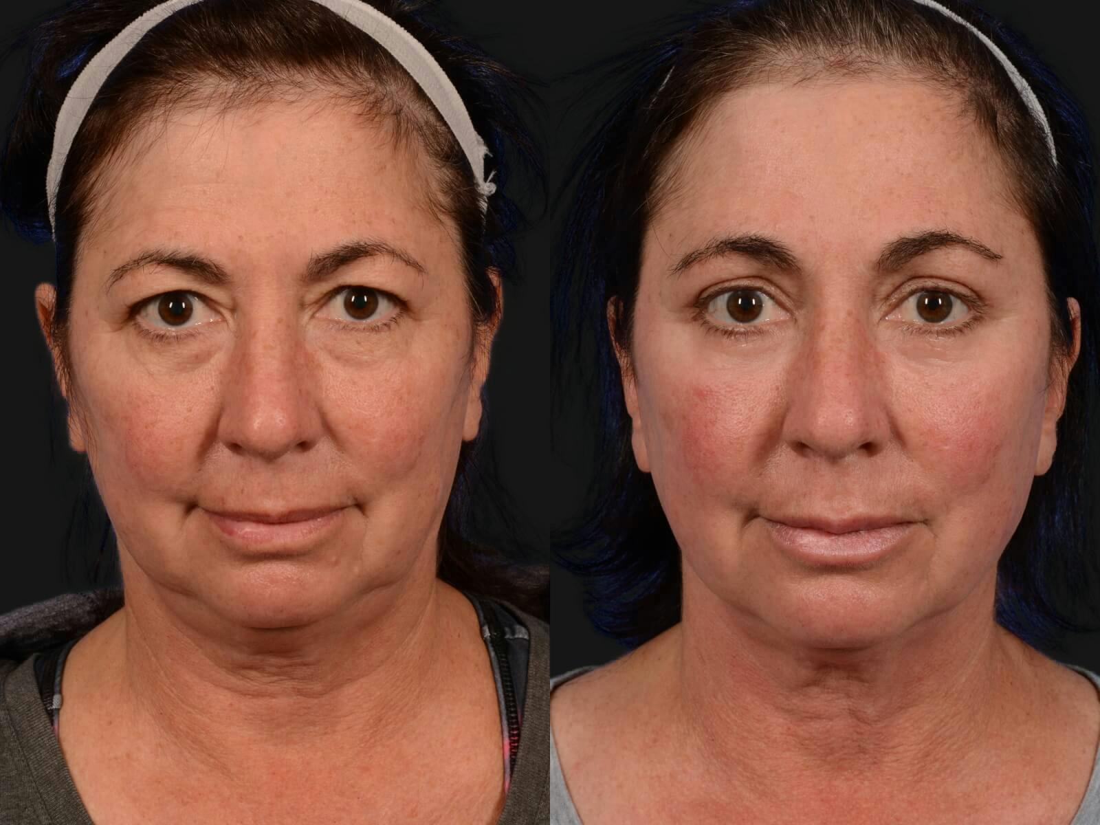 Blepharoplasty Before & After Gallery - Patient 422115 - Image 1