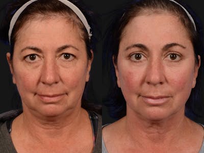 Blepharoplasty Before & After Gallery - Patient 422115 - Image 1