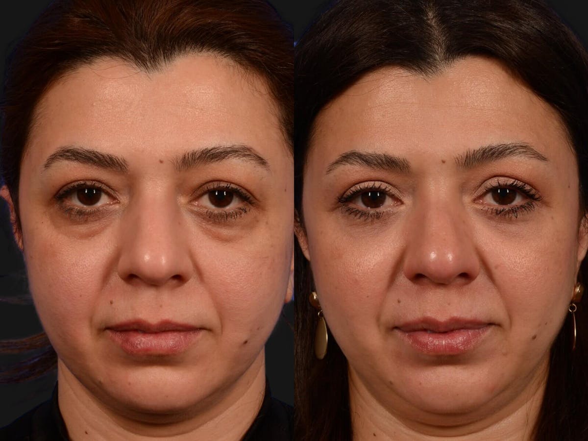 Blepharoplasty Before & After Gallery - Patient 266682 - Image 1