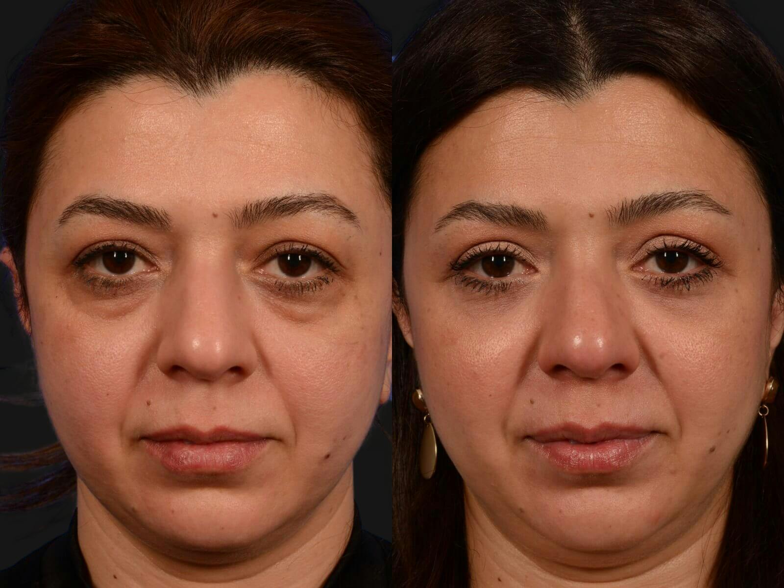 Blepharoplasty Before & After Gallery - Patient 266682 - Image 1