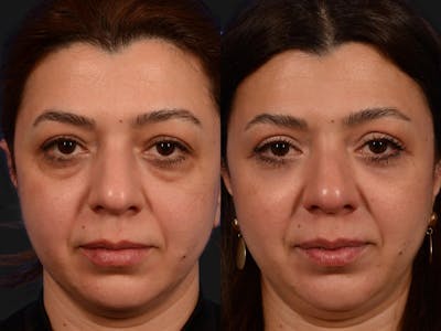 Blepharoplasty Before & After Gallery - Patient 266682 - Image 1