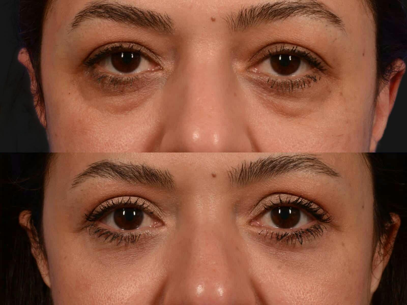 Blepharoplasty Before & After Gallery - Patient 266682 - Image 2