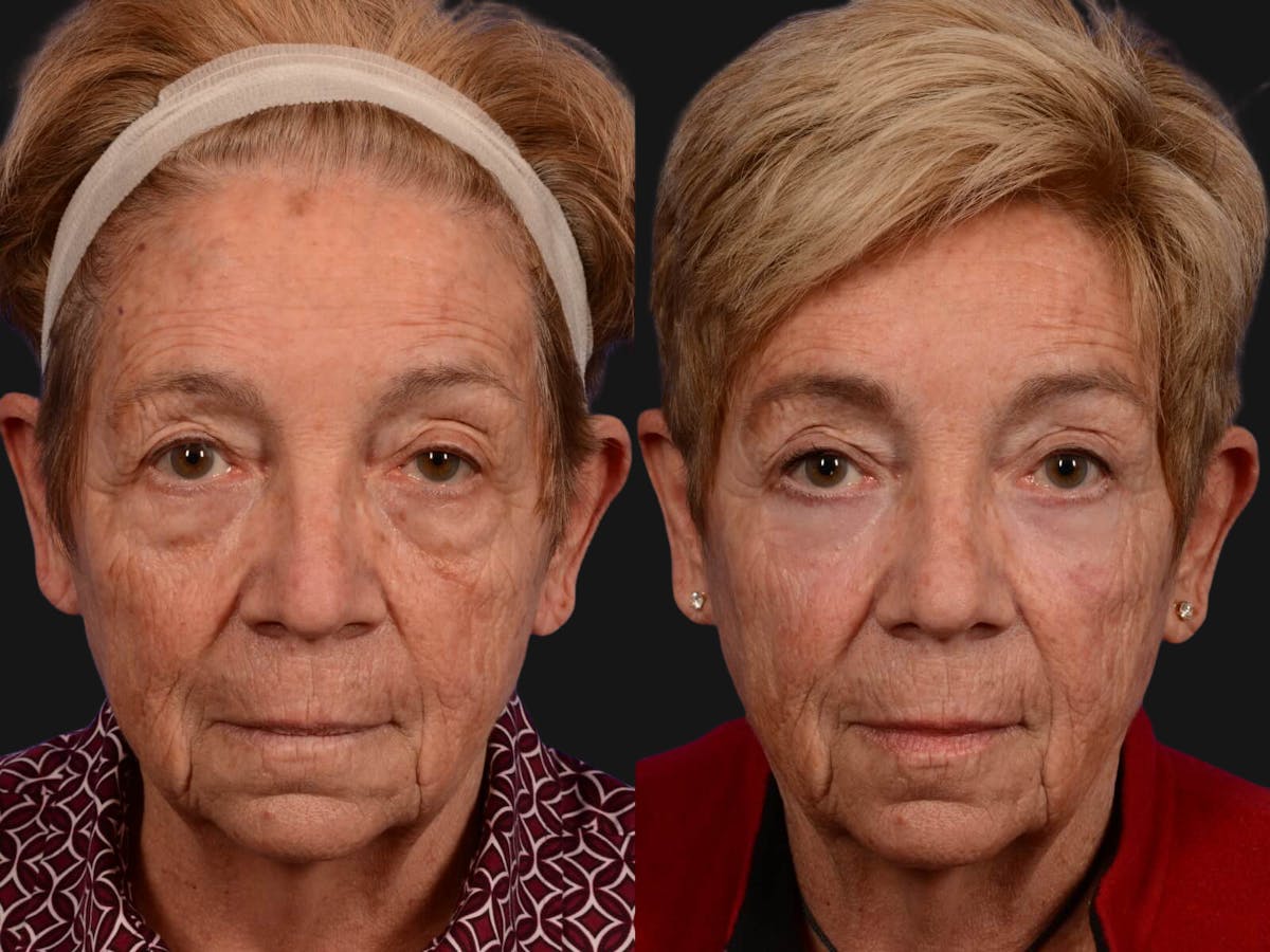 Blepharoplasty Before & After Gallery - Patient 129500 - Image 1