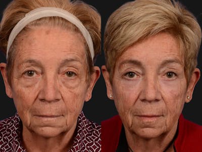 Blepharoplasty Before & After Gallery - Patient 129500 - Image 1
