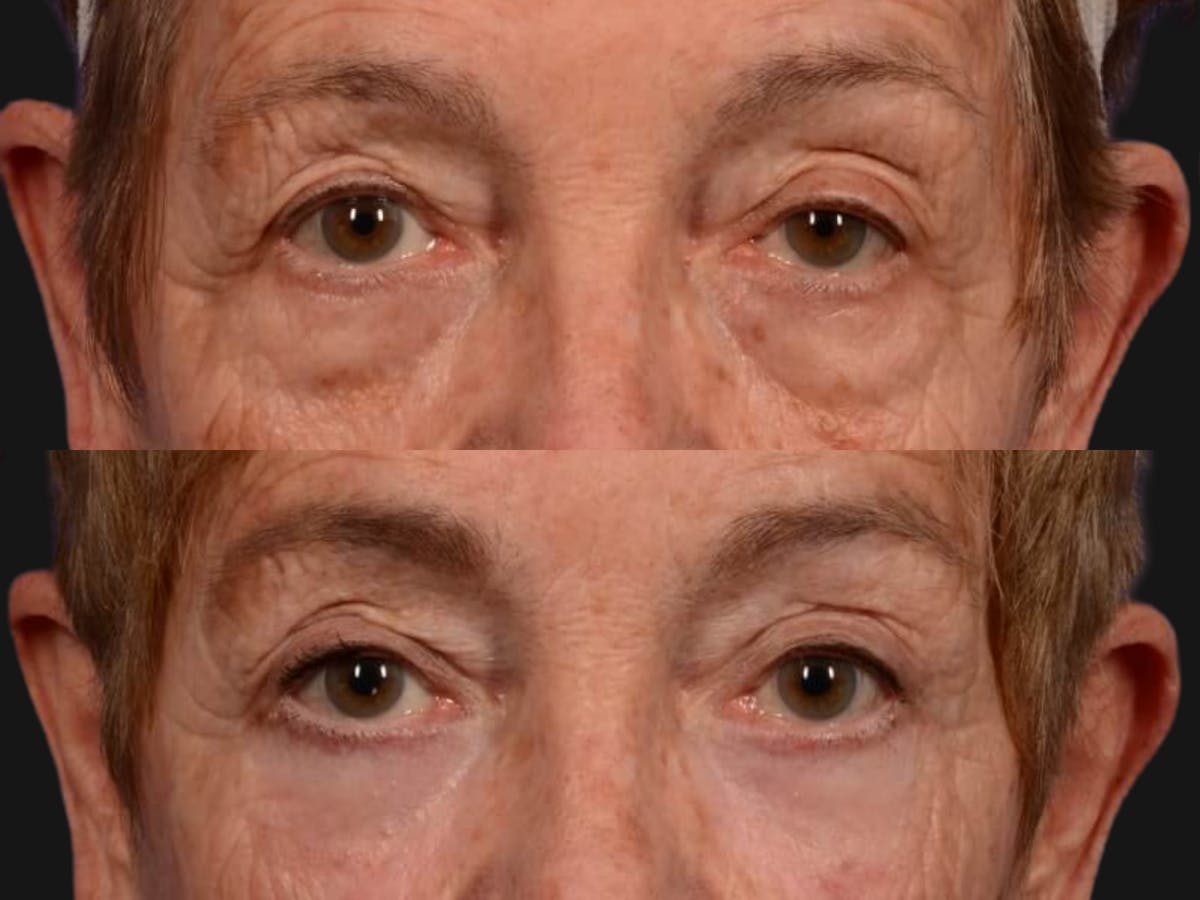 Blepharoplasty Before & After Gallery - Patient 129500 - Image 2
