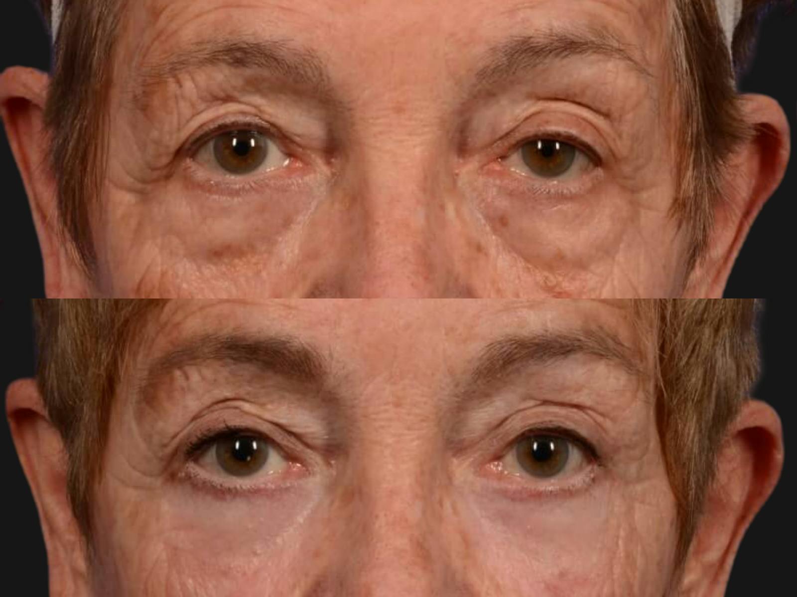 Blepharoplasty Before & After Gallery - Patient 129500 - Image 2