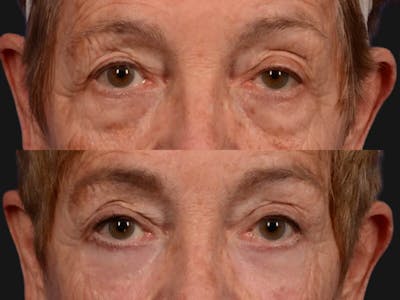 Blepharoplasty Before & After Gallery - Patient 129500 - Image 2