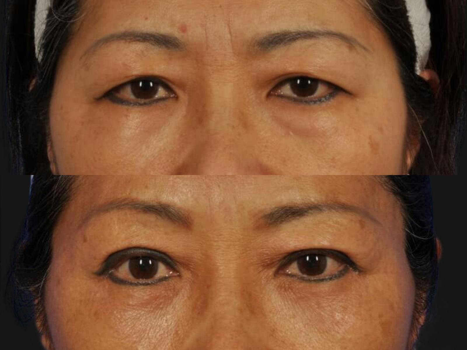 Blepharoplasty Before & After Gallery - Patient 335589 - Image 2
