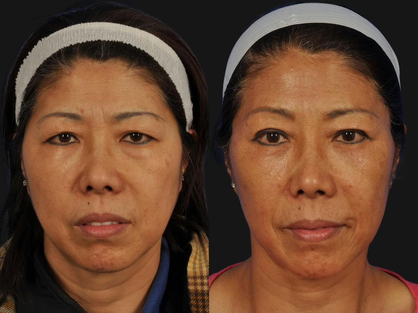 Blepharoplasty Before & After Gallery - Patient 335589 - Image 1