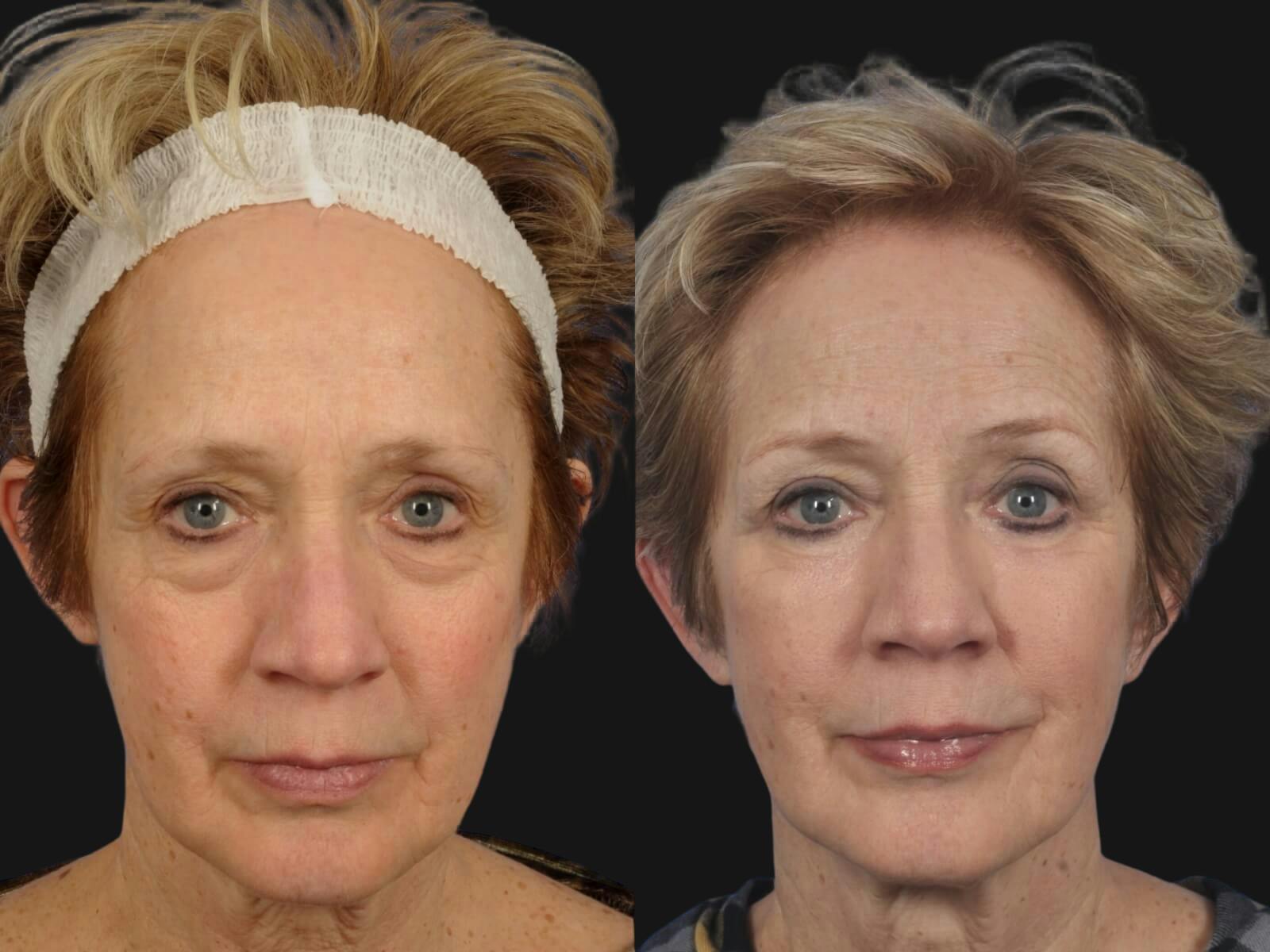 Blepharoplasty Before & After Gallery - Patient 246050 - Image 1