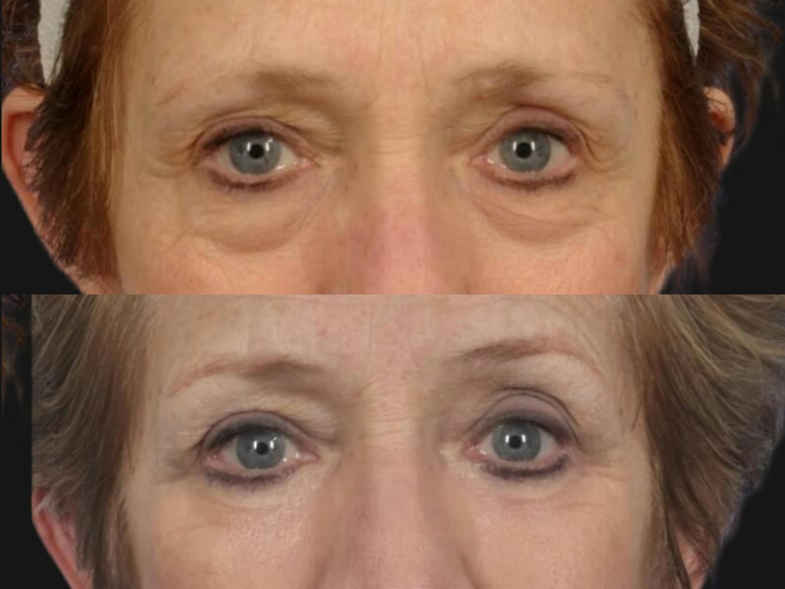 Blepharoplasty Before & After Gallery - Patient 246050 - Image 2