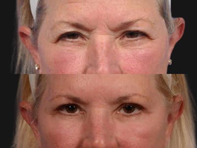Blepharoplasty Before & After Gallery - Patient 268624 - Image 2